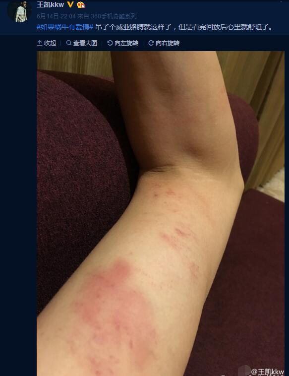 王凱曬“工傷”照惹“王妃”心痛：別太拼命