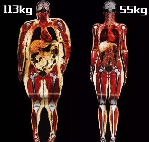 相同身高下，肥胖者與正常者皮下脂肪對(duì)比