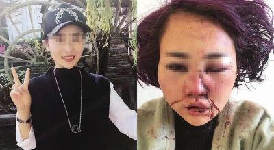 麗江被打毀容女子鑒定為輕傷 當事人:如何能接受