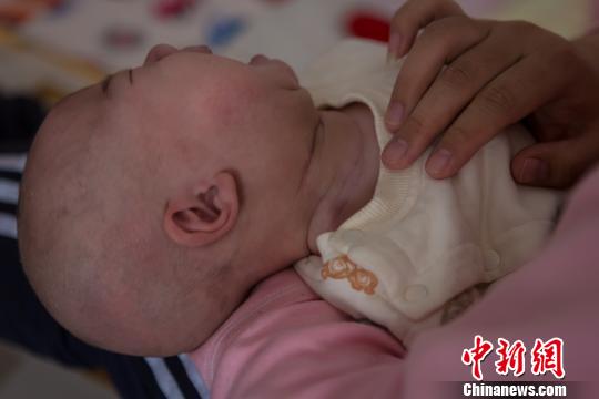 孩子出生后第15天，于麗靜發(fā)現(xiàn)小堅(jiān)果頸部右邊比左邊粗，而且長(zhǎng)出了花生米大小的包塊。孩子滿月時(shí)已長(zhǎng)到雞蛋黃那么大。圖為術(shù)后小堅(jiān)果的脖頸處留下的傷疤。范麗芳 攝