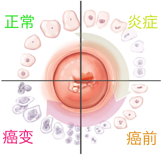 圖4。 子宮頸病變過(guò)程及細(xì)胞形態(tài)變化（來(lái)源：biology-forums.com）